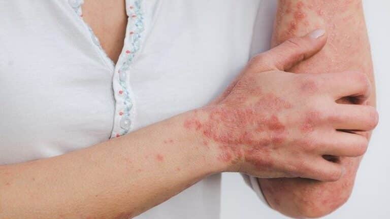 Ressentez-vous des démangeaisons ou des rougeurs ? Vous pourriez souffrir de psoriasis. Voici ce que vous devez savoir
