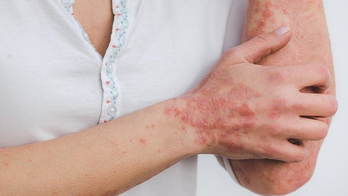 Ressentez-vous des démangeaisons ou des rougeurs ? Vous pourriez souffrir de psoriasis. Voici ce que vous devez savoir