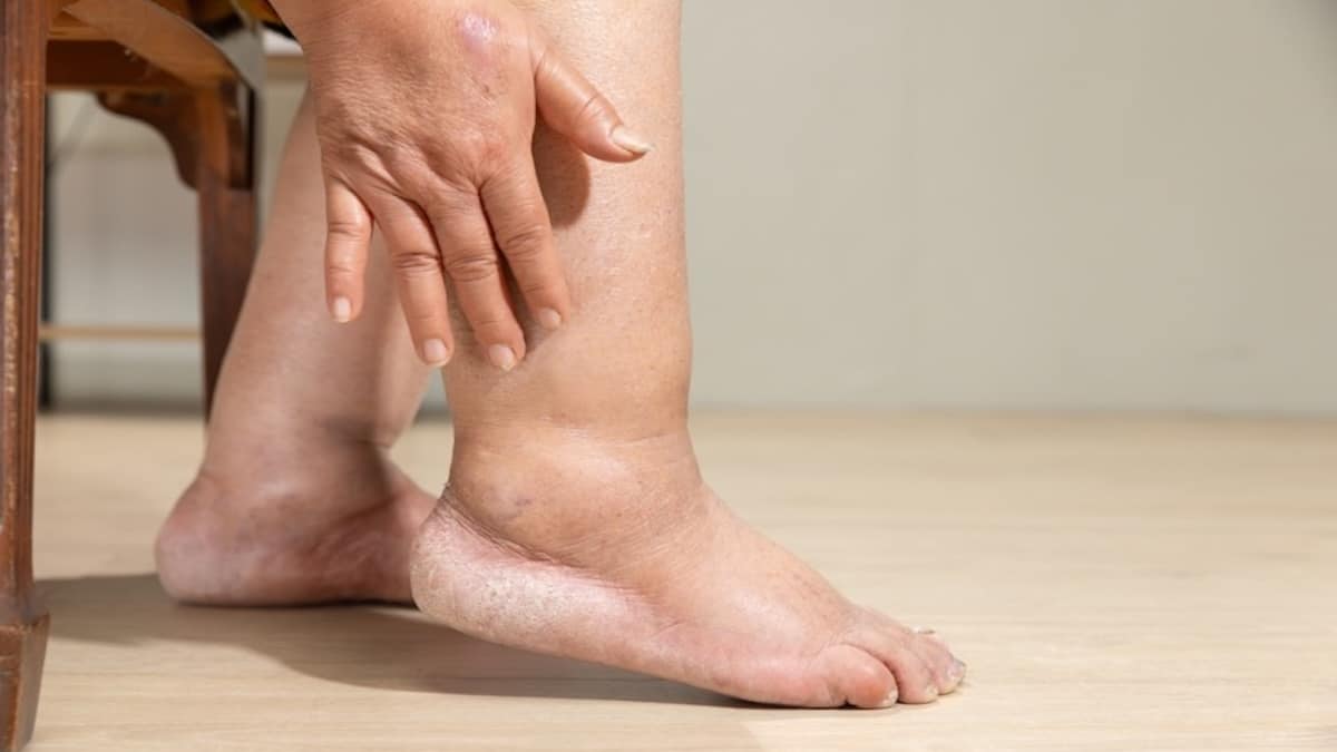 Votre pied est-il gonflé ? Ces premiers symptômes pourraient indiquer une maladie grave.