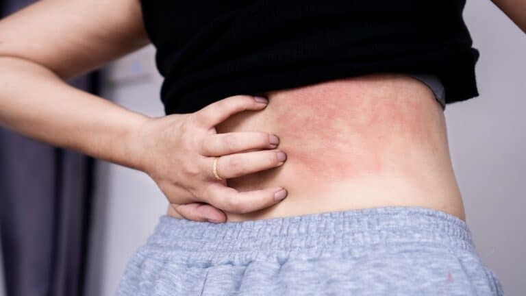 Allergie aux acariens : symptômes et causes