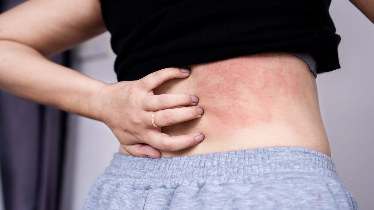 Allergie aux acariens : symptômes et causes